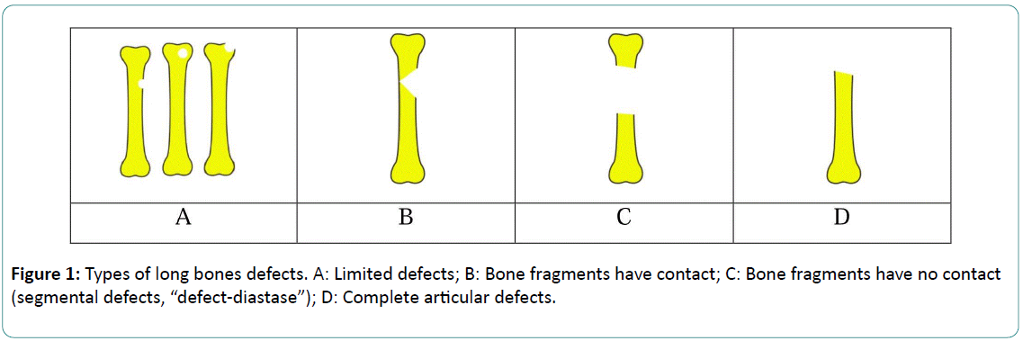 long-bone-defect-classification-what-it-should-be-insight-medical