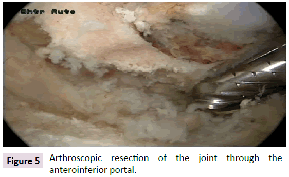 bone-Arthroscopic-resection-joint