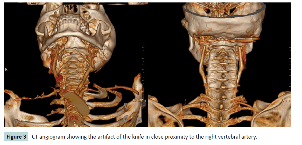 bone-CT-angiogram