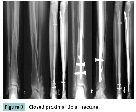 bone-Closed-proximal-tibial-fracture