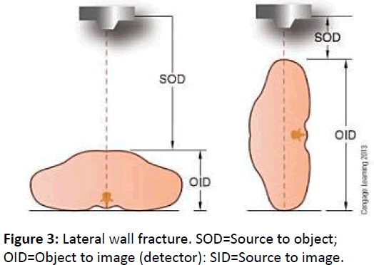 bone-Lateral-wall-fracture