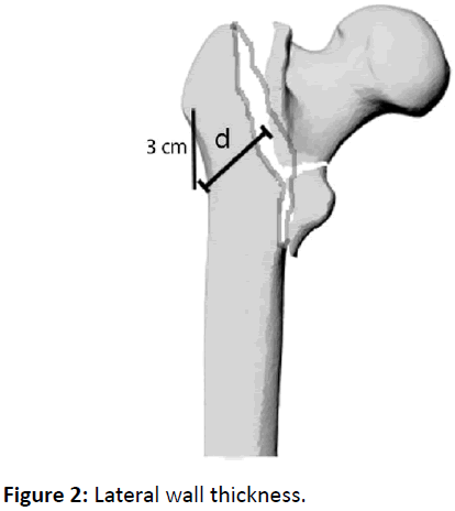bone-Lateral-wall-thickness