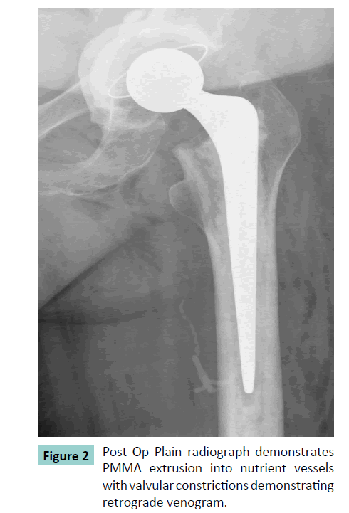 bone-PMMA-extrusion
