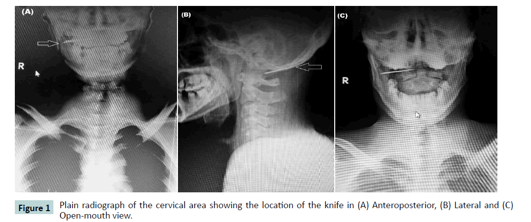 bone-Plain-radiograph
