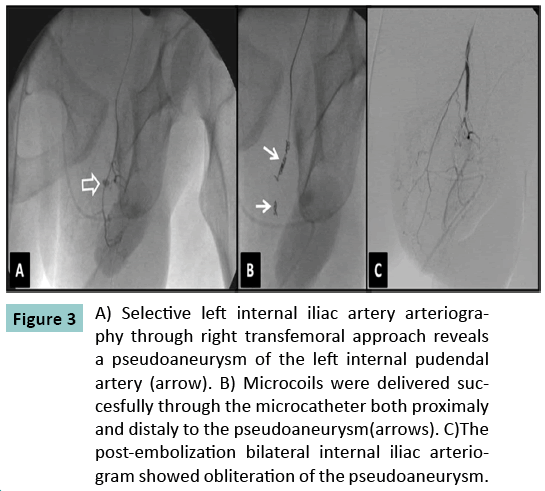 bone-Selective-left-internal