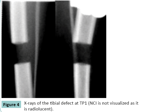 bone-X-rays-tibial-defect