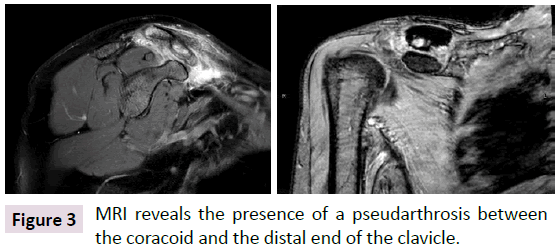 bone-distal-end-clavicle