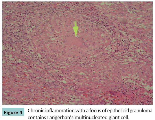 bone-focus-epithelioid-granuloma