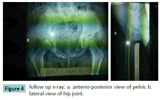 bone-follow-up-x-ray