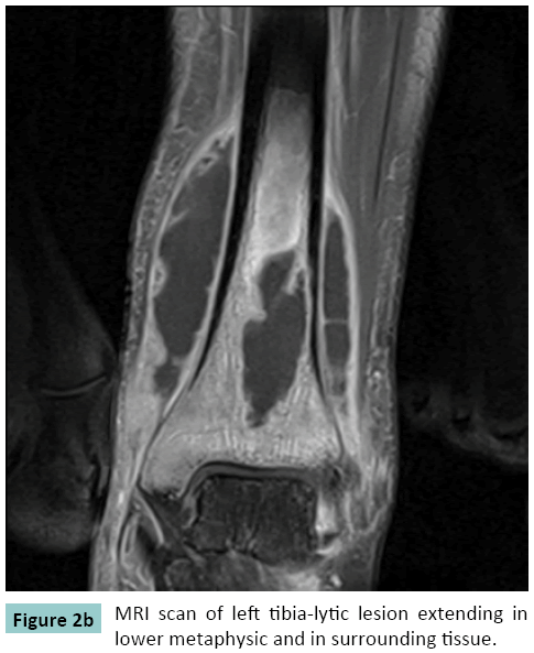bone-left-tibia-lytic-lesion