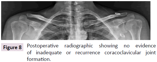 bone-recurrence-coracoclavicular-joint