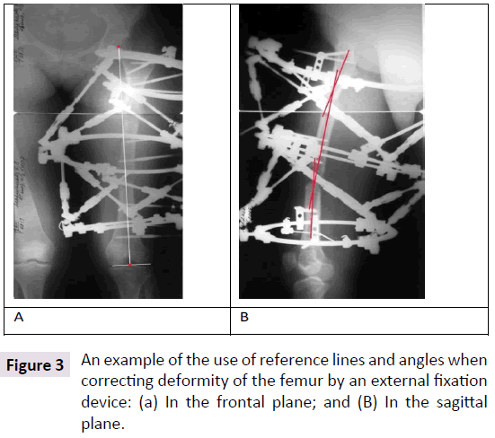 bone-reference-lines-angles