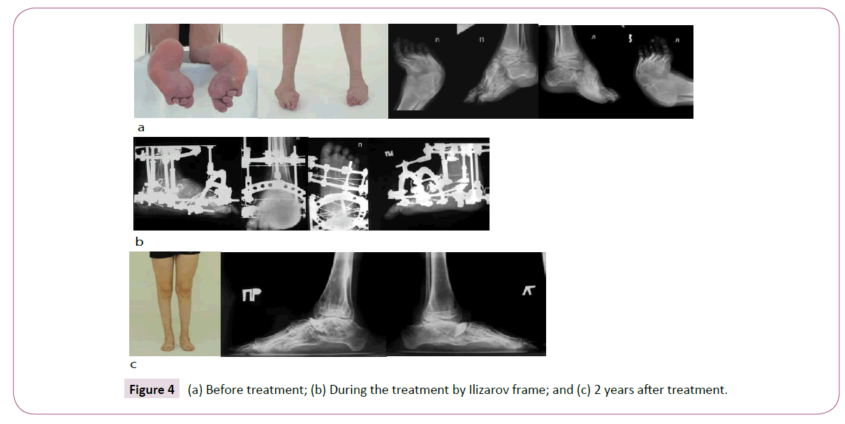 Tibia Ring Ilizarov External Fixation for Clubfoot Treatment - China  External Fixator, Ilizarov External Fixator