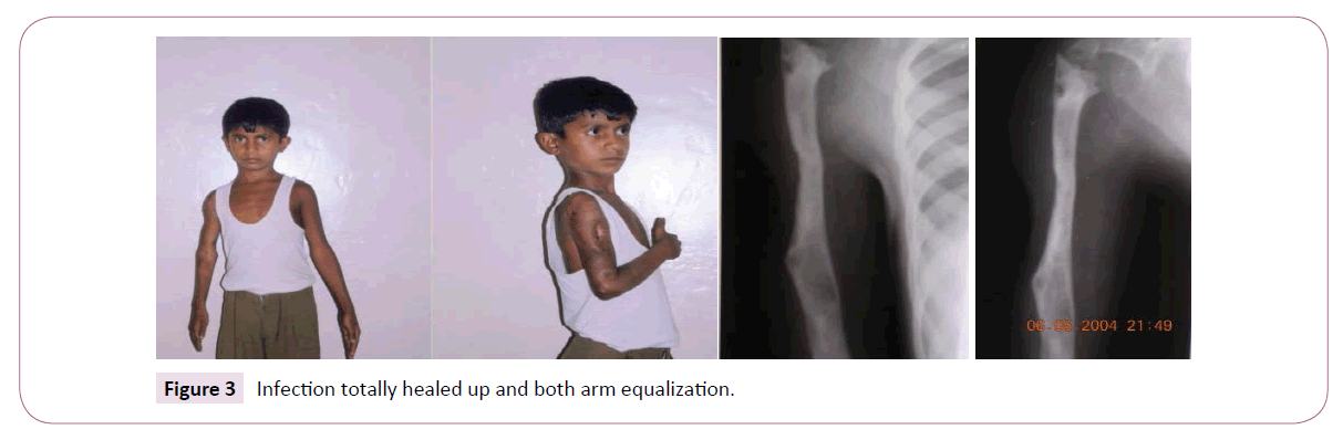 bone-reports-recommendations-arm-equalization