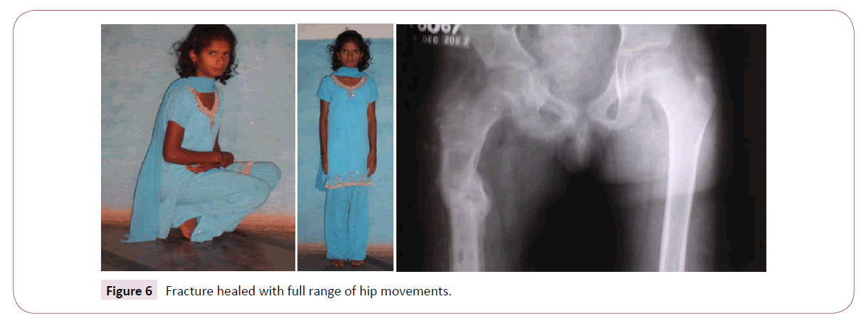 bone-reports-recommendations-hip-movements