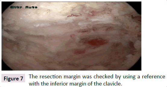 bone-resection-margin-clavicle