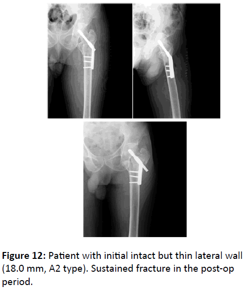 bone-thin-lateral-wall